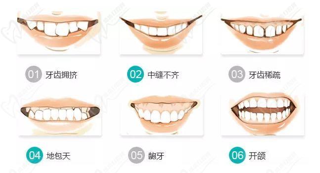 牙齒矯正