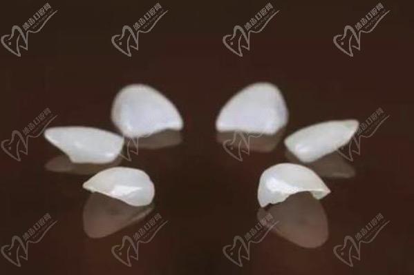 牙齒貼面多久可以做好？