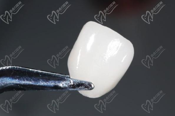 藍(lán)瓷貼面和鑄瓷貼面哪個(gè)好一點(diǎn)？