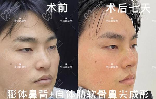 重慶李喆做鼻子怎么樣？口碑評價(jià)