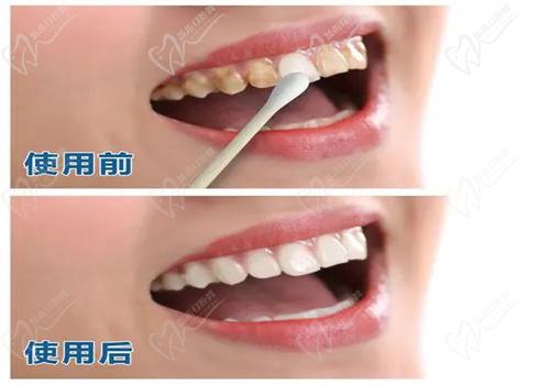 牙齒美白有哪些方法？