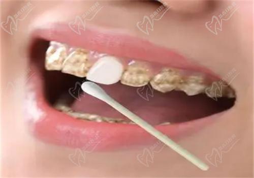 牙齒美白有哪些方法？
