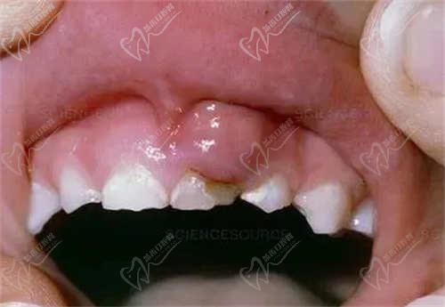兒童慢性根尖周炎會影響恒牙嗎？