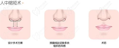 深圳福雅胡俊杰做人中縮短技術(shù)優(yōu)勢