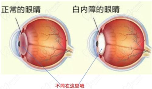 三、近視晶體植入手術(shù)的利與弊：