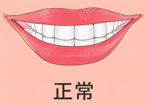 兒童早期矯正牙套的種類和價格